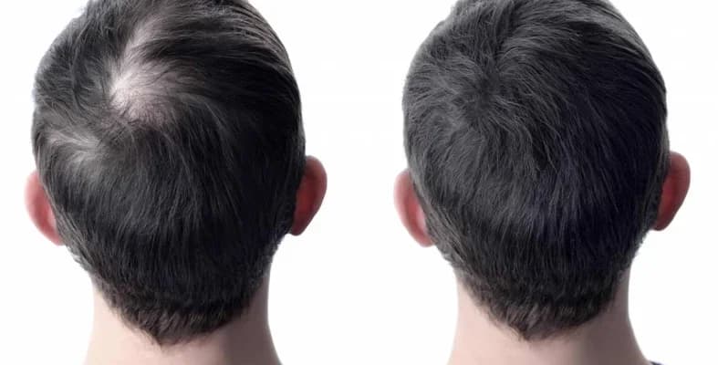 Hair Loss Treatment
