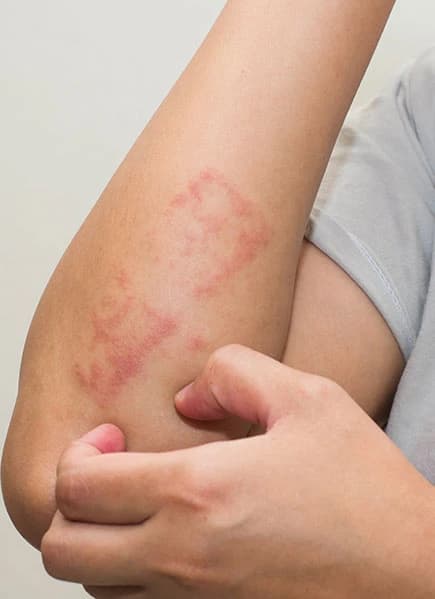 Skin & Nail Fungal Treatment